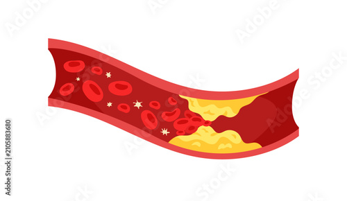 Atherosclerosis. Blocked blood vessel vector illustration. Plaque buildup restricting blood flow. Flat vector for medical, cardiovascular, healthcare, anatomy, disease, education.