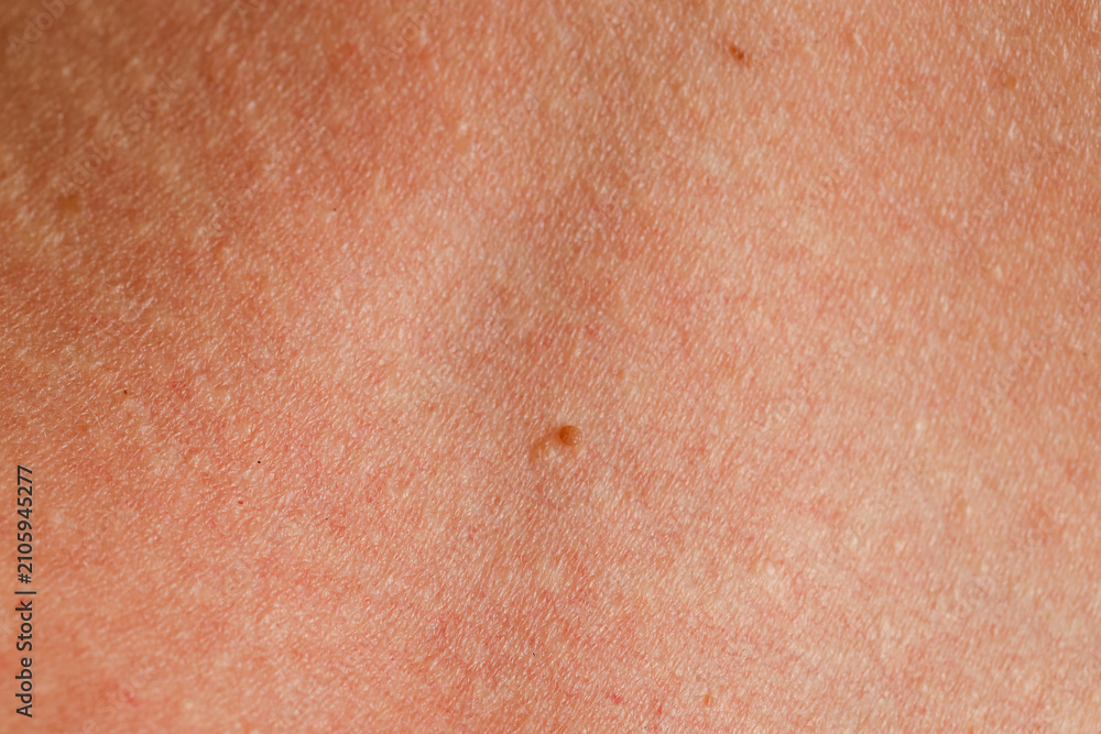 Fototapeta premium Texture of normal skin with birthmark as background, closeup