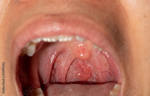 Bild auf Leinwand Close up of sore throat with swollen uvula, inflamed posterior pharyngeal wall and visible lymphoid follicles inside the oral cavity