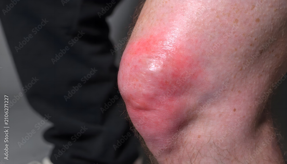 Fototapeta premium Swollen kneecap from prepatellar bursitis, housemaid knee inflammation, lateral view for medical and occupational health