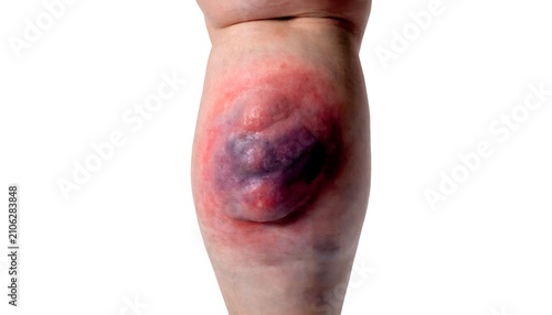 Calf muscle hematoma with swelling and discoloration, posterior leg view, clinical medical documentation isolated on white background