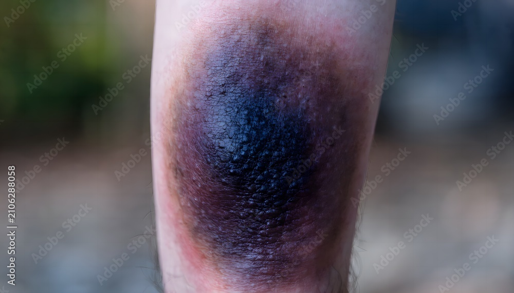 Fototapeta premium Direct shin impact contusion with bone bruising, macro close up view, clinical medical reference photography documentation