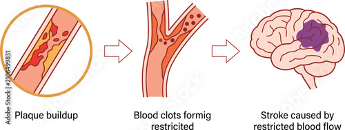 Tableau sur toile Medical vector diagram of ischemic stroke, showing plaque buildup, blood clots,