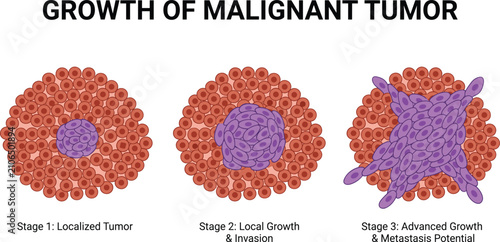 Foto Medical vector illustration showing the growth stages of a malignant tumor and m