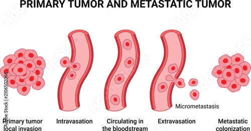 Foto Medical vector illustration showing primary tumor, bloodstream intravasation, an
