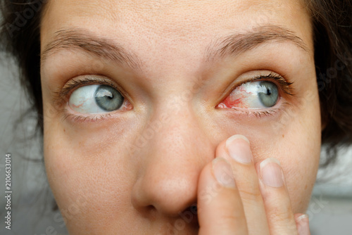 Schilderij op canvas Close up of woman pulling down lower eyelid showing red bloodshot eye with conju