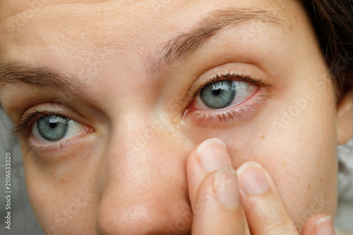 Photos Close up of woman pulling down lower eyelid showing red bloodshot eye with conju