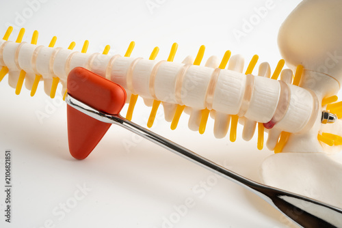 Fotografie Human spinal nerve and bone with percussion reflex hammer, model for treatment medical in the orthopedic department