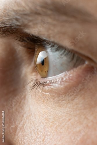Obraz na płótnie Conical cornea deformity in severe keratoconus patient