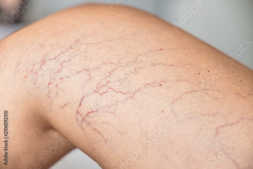Fotografía Close-up of lower leg with spider veins and superficial telangiectasia