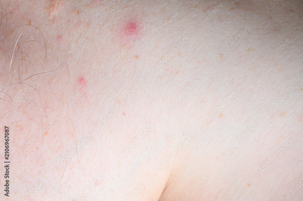 Fototapeta premium Close-up of fair skin with red blemishes, irritated spot and fine hair follicles