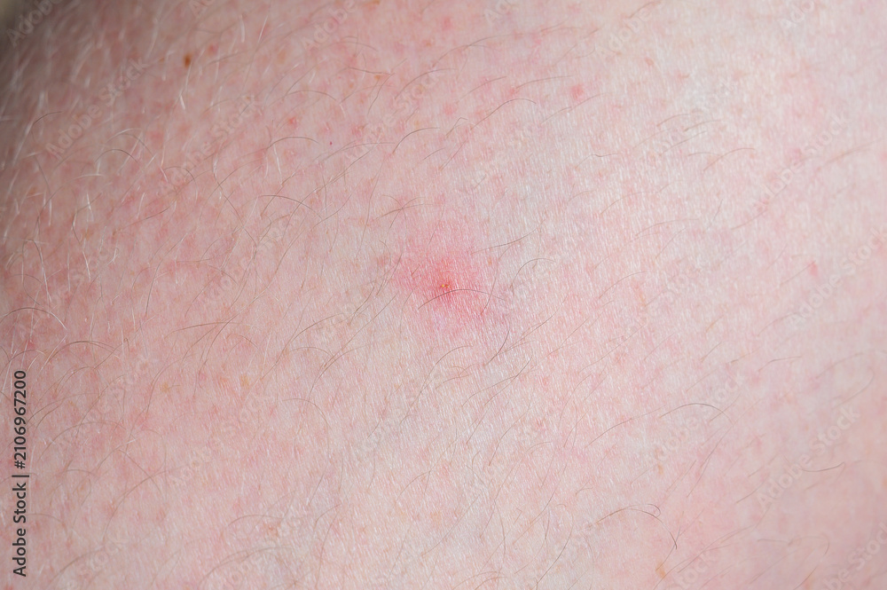 Fototapeta premium Close-up of fair skin showing a small red irritated spot and fine hairs