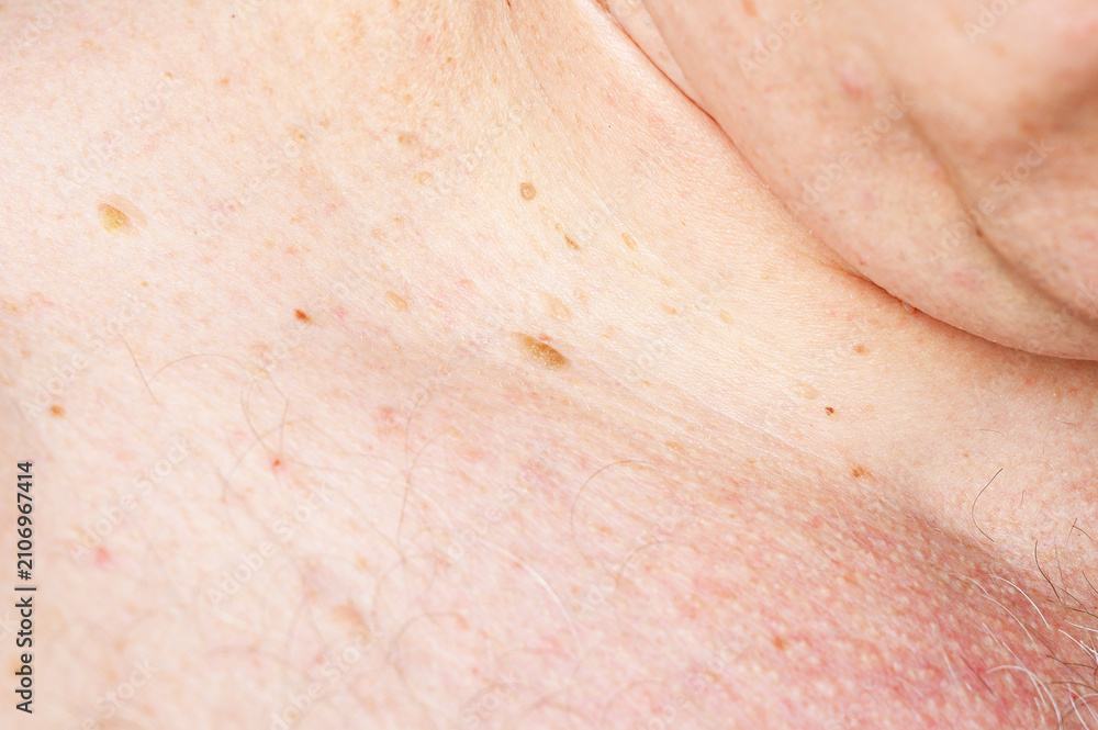Fototapeta premium Close-up of aging skin with multiple skin tags and moles on chest area