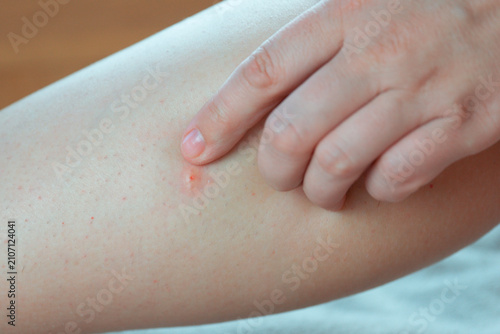 Foto hand with clean fingernails gently touches an inflamed insect bite on the skin o