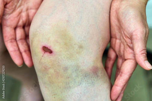 Quadro su tela Scraped knee on a female leg with a large healing yellowish-purple bruise and a small bloody wound, close up