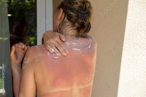 Obraz na płótnie Woman applying panthenol spray to her sunburned back, shoulders after prolonged sun exposure