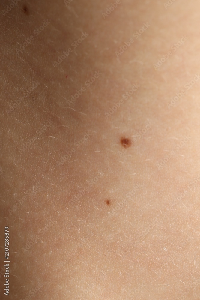 Fototapeta premium Texture of normal skin with birthmarks as background, closeup