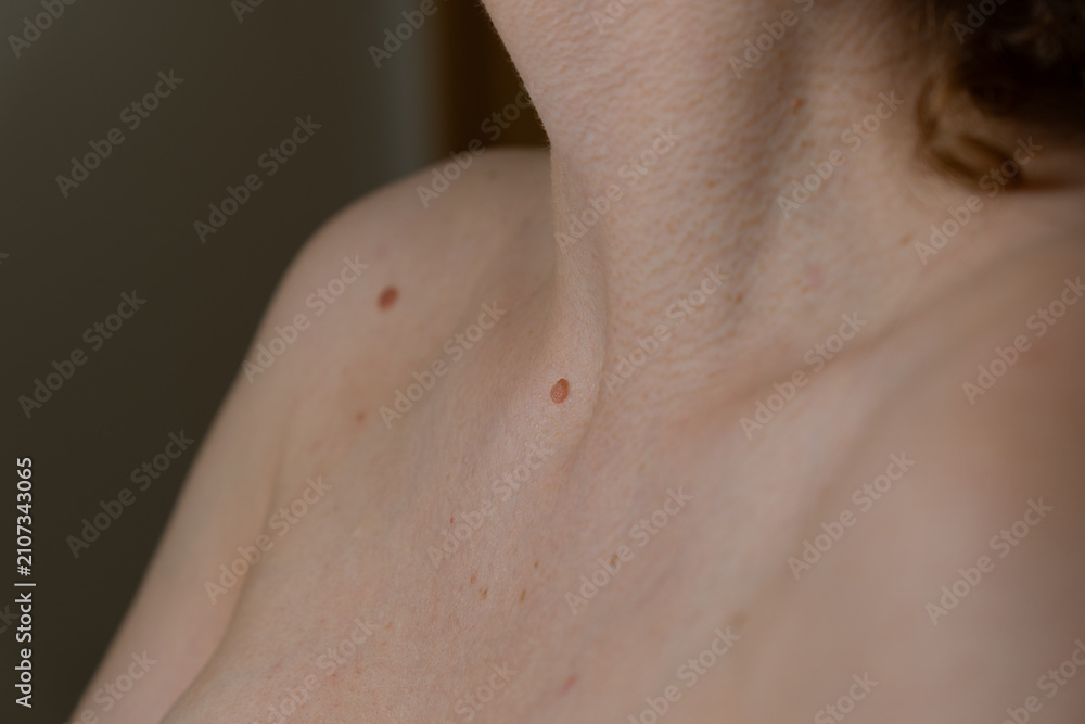 Fototapeta premium Close-Up of Human Skin Texture with Benign Moles on Neck and Collarbone, Dermatology and Skin Health Concept
