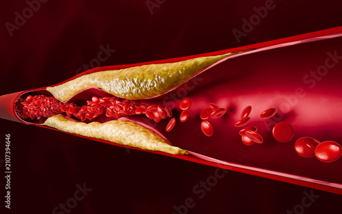 Foto Cross section of narrowed artery filled with cholesterol plaque demonstrating reduced circulation, vascular obstruction, and progression of atherosclerosis in the cardiovascular system