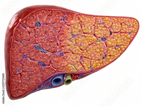 3D anatomical cross section of a human liver showing fatty liver disease liver steatosis
