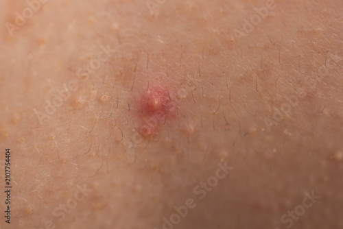 Obraz na plátne Irritated skin with pimples acne texture