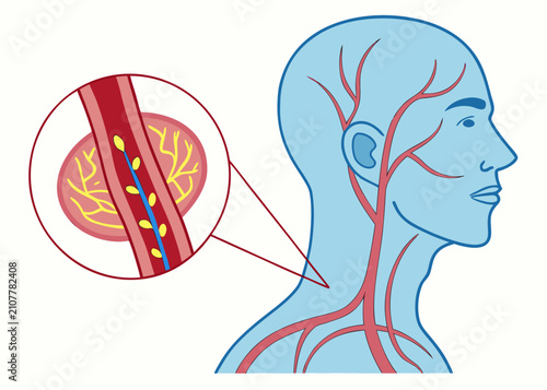 Cuadro en lienzo Atherosclerosis causing carotid artery stenosis and impaired cerebral blood circulation