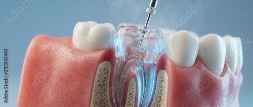 Detailed 3D Illustration of Root Canal Treatment on a Tooth Model.