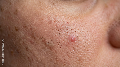 Close-up of Acne and Pores: A macro view reveals the intricate details of human skin, showcasing enlarged pores, blackheads, and a red pimple, highlighting common dermatological concerns.