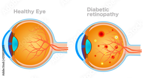 Cuadro en lienzo Diabetic retinopathy structure, anatomy