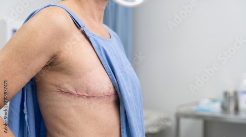 Woman showing mastectomy scar on chest in medical clinic