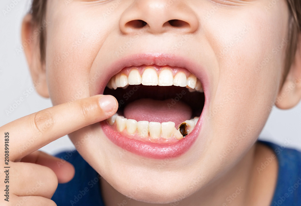 Fototapeta premium Child smiles wide, showing clean teeth