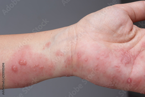 Shingles, Zoster or Herpes Zoster symptoms on arm and hand