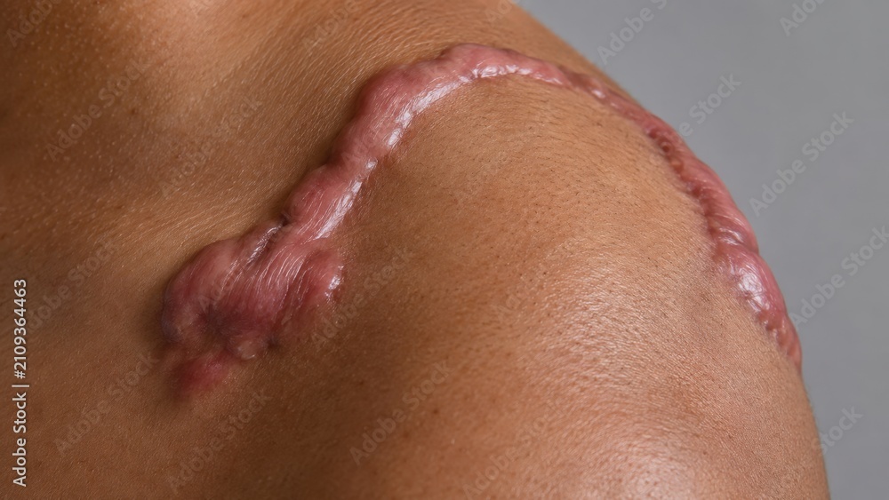Fototapeta premium Close-up of Raised Pink Scar on Shoulder Showing Skin Texture and Healing Process