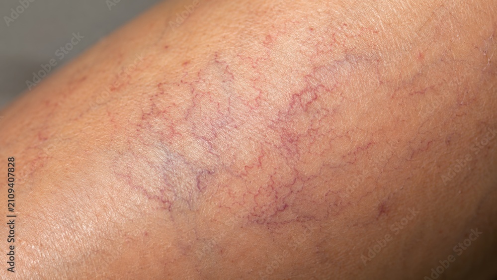 Fototapeta premium Macro of spider veins on human lower leg