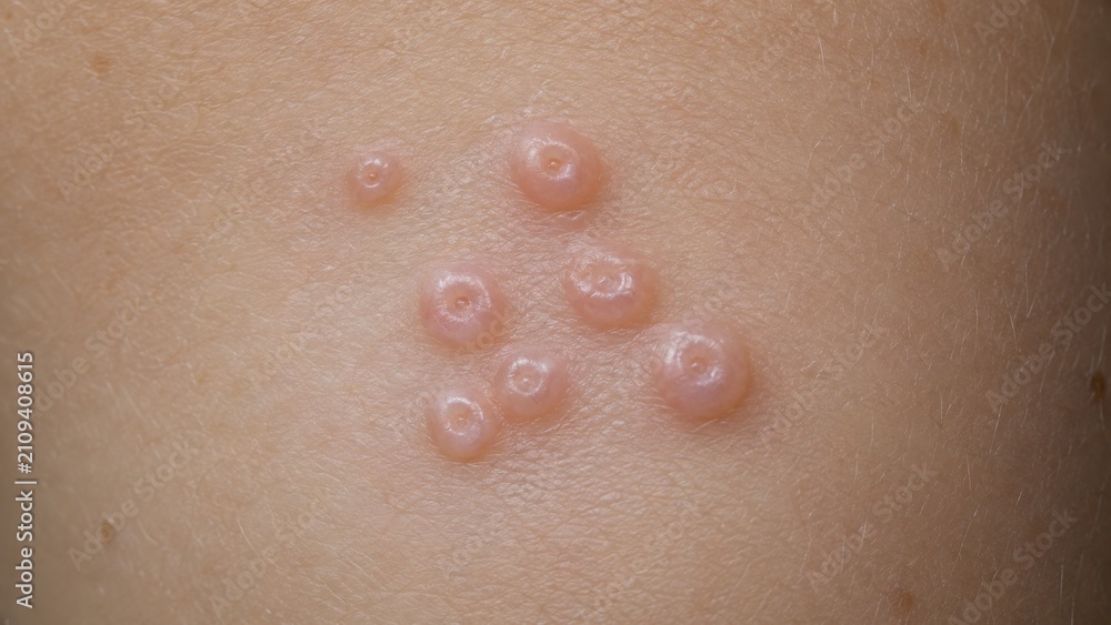 Fototapeta premium Macro shot of molluscum contagiosum papules on skin