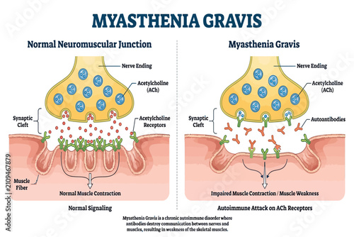 Medical illustration explaining the pathophysiology of Myasthenia Gravis at the neuromuscular junction