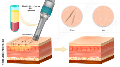 Platelet-Rich Plasma PRP with Microneedling for Skin Rejuvenation and Scar Reduction Medical Illustration. PRP  Therapy Before and After Skin Regeneration Cross Section 