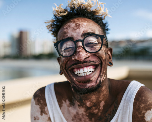 Happy person with vitiligo, happy lifestyle, diversity portrait.