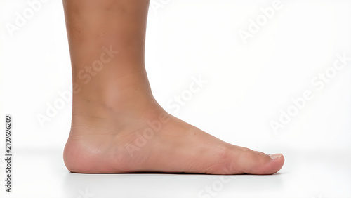 Flat feet with collapsed medial arch in adult foot, photorealistic medical 3D render on white background for podiatry, orthopedic healthcare, medical education, and patient information design