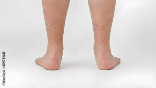 Flat feet with pronated foot alignment in adult barefoot standing pose, photorealistic medical education image of collapsed arches for podiatry, orthopedics, healthcare and patient communication