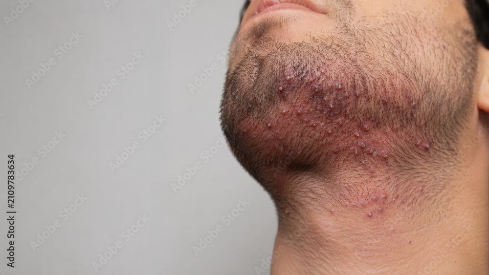 Naklejka premium Close up of red irritated skin with acne and pimples on male chin and jawline with facial hair