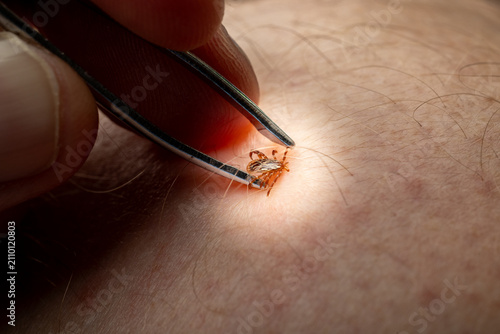 фотографія Removing Tick with Fine-Tipped Tweezers