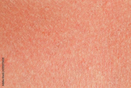 Cuadro en lienzo Texture of normal skin as background, closeup