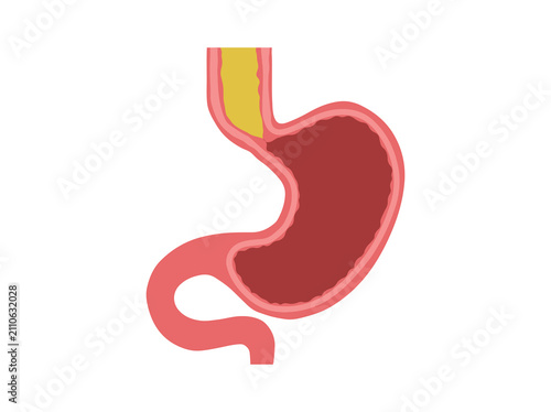Achalasia Disease in Stomach Illustration