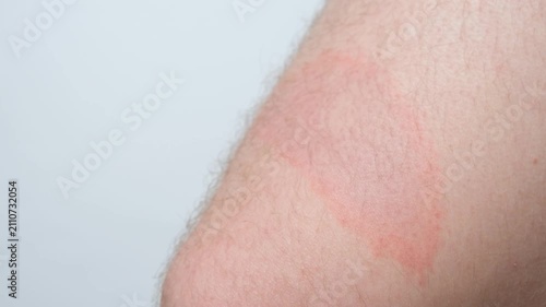 Close-up of circular red skin lesion characteristic of Borreliosis infection after a tick bite.