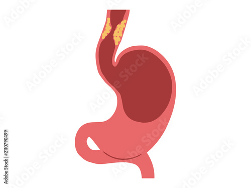 Esophageal Cancer Disease in Stomach