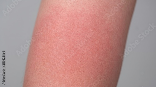 Severe skin redness and erythema from acute sunburn on arm