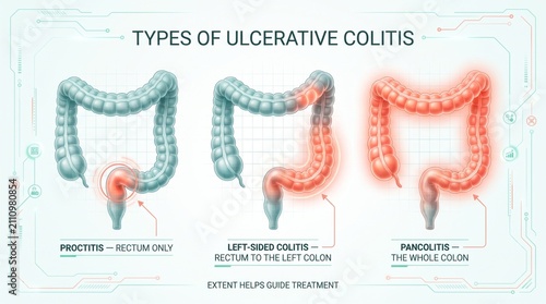 Types of ulcerative colitis