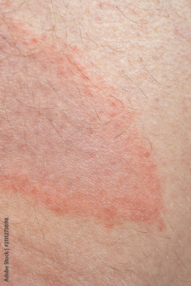 Fototapeta premium Close-up of circular red skin lesion characteristic of Borreliosis infection after a tick bite