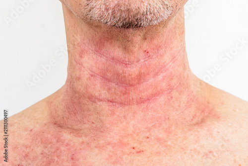 Foto Close-up of an adult man's neck with red inflamed atopic dermatitis skin texture, dermatology medical reference, eczema treatment context